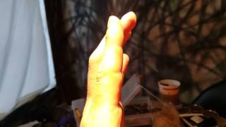 Flexor tendon surgery 10 weeks post op [upl. by Schindler]