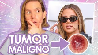 KHLOE KARDASHIAN tiene un TUMOR EN LA CARA  Todo sobre su tumor maligno  Simon Scarano Dermatologo [upl. by Bibah237]