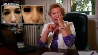 0 CHIRURGIE  Comment affiner son nez grâce au maquillage  le contouring du nez Colashood2 [upl. by Hillyer]