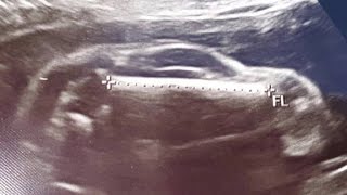 Sonogram shows WHAT [upl. by Ornas282]