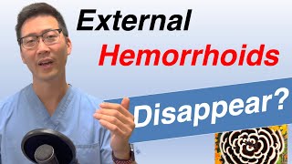 Can External hemorrhoids go away on their own Does treatment matter [upl. by Anitnatsnoc]