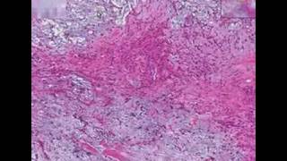 Histopathology Salivary glandPleomorphic adenoma mixed tu [upl. by Aivull]