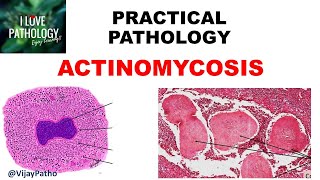 Practical Pathology ACTINOMYCOSIS [upl. by Pantin]