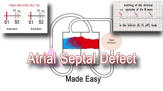 Atrial Septal Defect ASD Pathophysiology amp Clinical Features [upl. by Akilegna307]