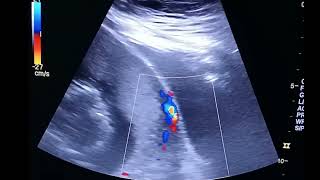 ultrasound of placenta accreta [upl. by Nosae361]