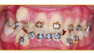 BraCKETS antes y DESpués MiRa CoMo FunCiOnAn😁 [upl. by Heidt]