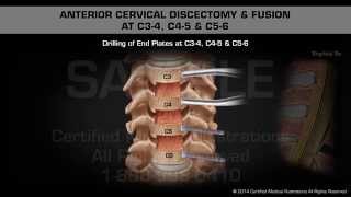 Anterior Cervical Discectomy amp Fusion at C34 C45 amp C56 [upl. by Enatan]