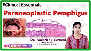 Paraneoplastic pemphigus Clinical essentials Dr Aashritha yerneni [upl. by Combes328]