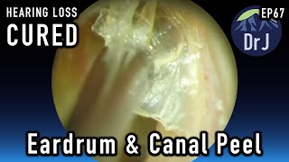 EP67  EAR DRUM and CANAL PEEL  HEARING LOSS CURED  4KHD [upl. by Negaet]