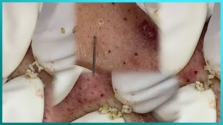 Big Cystic Acne Blackheads Extraction Blackheads amp Milia Whiteheads Removal Pimple Popping [upl. by Laefar]