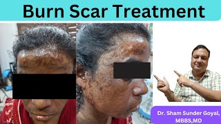 Odisa Burn Scar Client  Combination Treatment  Hypertrophic Scars  Pinholex  Kayalkalp Laser [upl. by Cochran785]