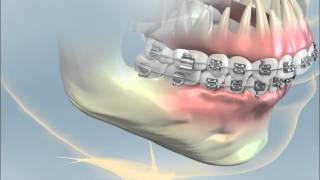 YORK ORTHODONTICS Orthognathic Surgery Class II [upl. by Chinua]