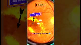 Diabetic Retinopathy  CSME  Retina  Short Video 170 akleshkumar optometrist [upl. by Ahsinirt]