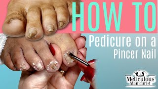 👣HOW TO DO A PEDICURE on a Pincer Toenail👣 [upl. by Ayekehs]