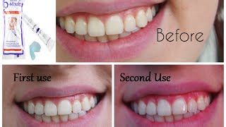 Does This work 5 Minute Teeth Whitening Dollar Tree Products Review [upl. by Cottle982]