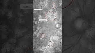 Be aware of how to identify Yasunari nodules in Neurofibromatosis Type 1 NF1 using NearInfrared [upl. by Tyree]