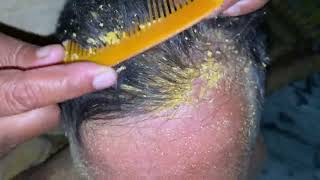 How to get rid old dandruff flakes scratchy  how to get rid flakes in your hair [upl. by Yramanna]