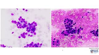 Compare and Contrast Pancreatic Cytology [upl. by Porter226]