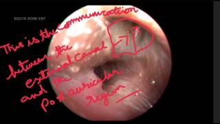 POST AURICULAR SINUS [upl. by Yeliab]