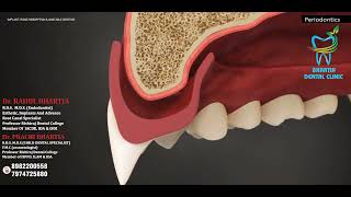 DENTURE  PERIODONTICS [upl. by Orgalim259]