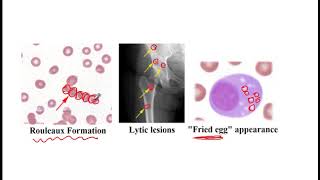 USMLE ACE Video 60 Multiple myeloma Waldenström macroglobulinemia and MGUS [upl. by Switzer508]