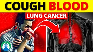 Coughing up Blood and Lung Cancer  Hemoptysis [upl. by Anuahsal298]