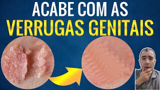 Como remover e destruir VERRUGA NA GENITAL por HPV [upl. by Mctyre]