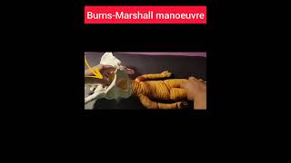 Burns  Marshall Techniquenormaldelivery normallabour breechdelivery [upl. by Yorle]