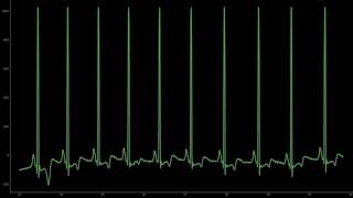 Electrocardiogramme ECG avec extrasystole avec son 1 minute [upl. by Gervais]