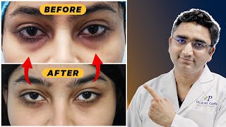 Eye Bags  Puffy Eyes Solution [upl. by Eriuqs]