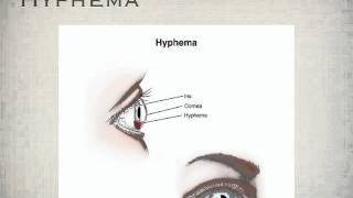 hyphema [upl. by Nork]