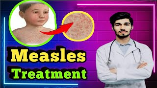 How to treat Measles quickly  Measles Treatment step by step [upl. by Leinoto640]