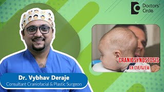 CRANIOSYNOSTOSIS Diagnosis amp Treatment children plasticsurgery DrVybhav Deraje Doctors Circle [upl. by Udale408]