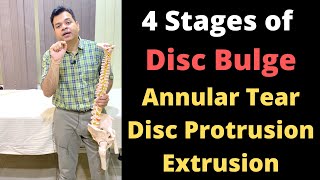 Stages of Disc Bulge Annular Tear Disc Protrusion Disc Extrusion Herniated Disc Stages [upl. by Millard720]