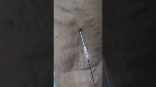 Varicose Veins treatment by Dr Hussain at Hussaingreekcliniccom without surgery drhussain [upl. by Ajup]