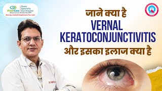 क्या है Vernal Keratoconjunctivitis और इसका इलाज क्या है  VisionCare Super Specialty Eye Hospital [upl. by Gallagher]