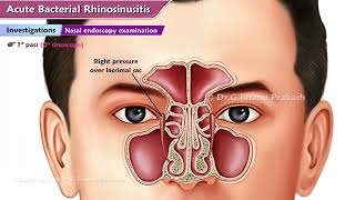 Acute Bacterial Rhinosinusitis ABRS  ENT Lectures [upl. by Ahen]