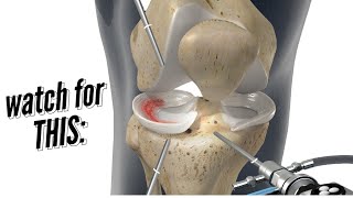 Meniscus Repair vs Meniscectomy [upl. by Yusuk]