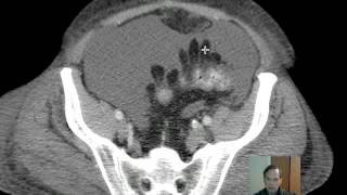 CT Epiploic Appendages Discussion [upl. by Derman]