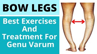 Bow Leg Correction Exercises And Treatment  How To Recover Bow Legs and Knee Pain In Hindi [upl. by Drucy914]