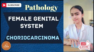 What Is CHORIOCARCINOMA In Pathology [upl. by Vaules]