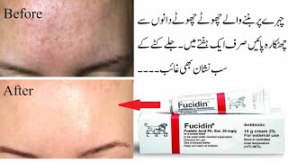 Fucidin Cream Complete Review  Ointment For tiny bumps on face  My acne care routine  Hania Qasim [upl. by Deery]