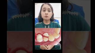 Why dental cap is important after RCT 9988401892  8198841892 mydentistchandigarh dentalawareness [upl. by Enyrhtac]