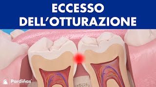 Problemi di riempimento – Eccesso dell’otturazione dentale © [upl. by Gwen496]