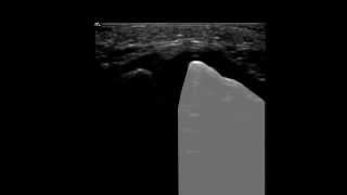 Musculoskeletal Ultrasound Shoulder 6 acromioclavicular joint scan [upl. by Naillik116]