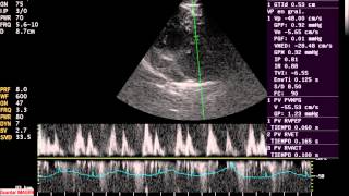 ENFERMEDAD VALVULAR MITRAL CANINOS [upl. by Lore]