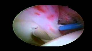 Labral Tear  Detached Anterior Labrum [upl. by Leena]