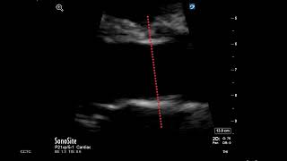 How to Measure LVOT Diameter [upl. by Eico]