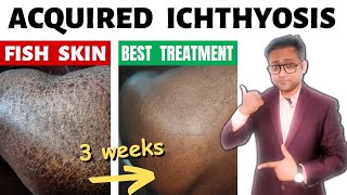 Acquired ichthyosis  Fish skin  Treatment  Hindi [upl. by Mayce976]