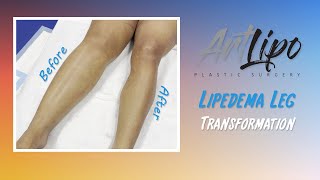 Cankles amp Knees Liposuction  Lipedema Legs  Lipo 360°  Expert Dr Thomas Su [upl. by Kohsa]